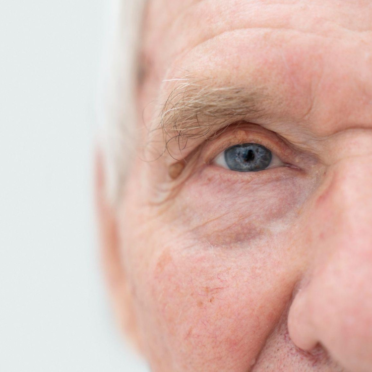 Cuidados com a visão: como prevenir cataratas oculares